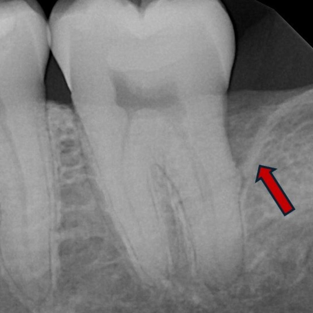 Guided Tissue Regeneration