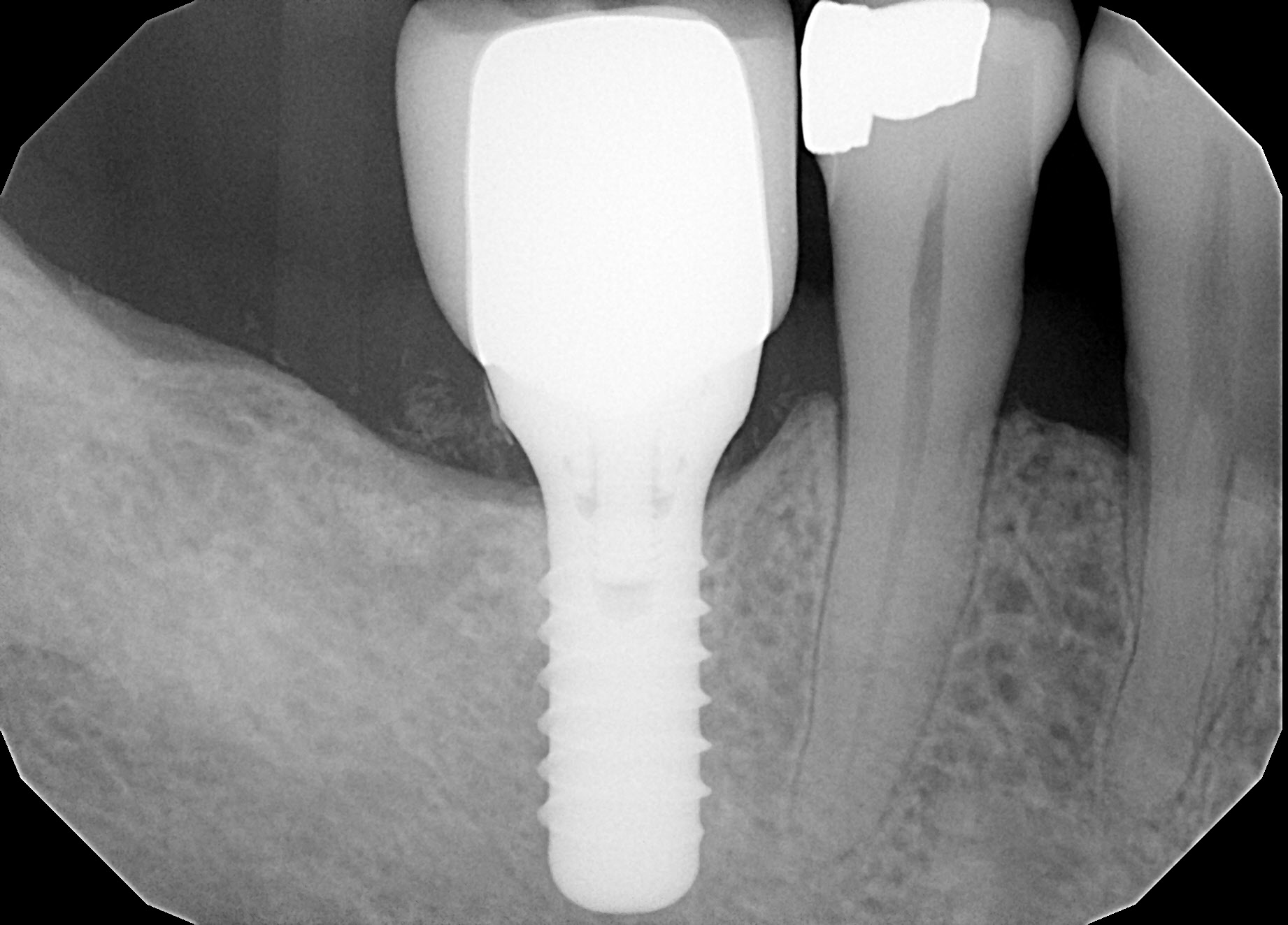 Guided Bone Regeneration after | brandon periodontics