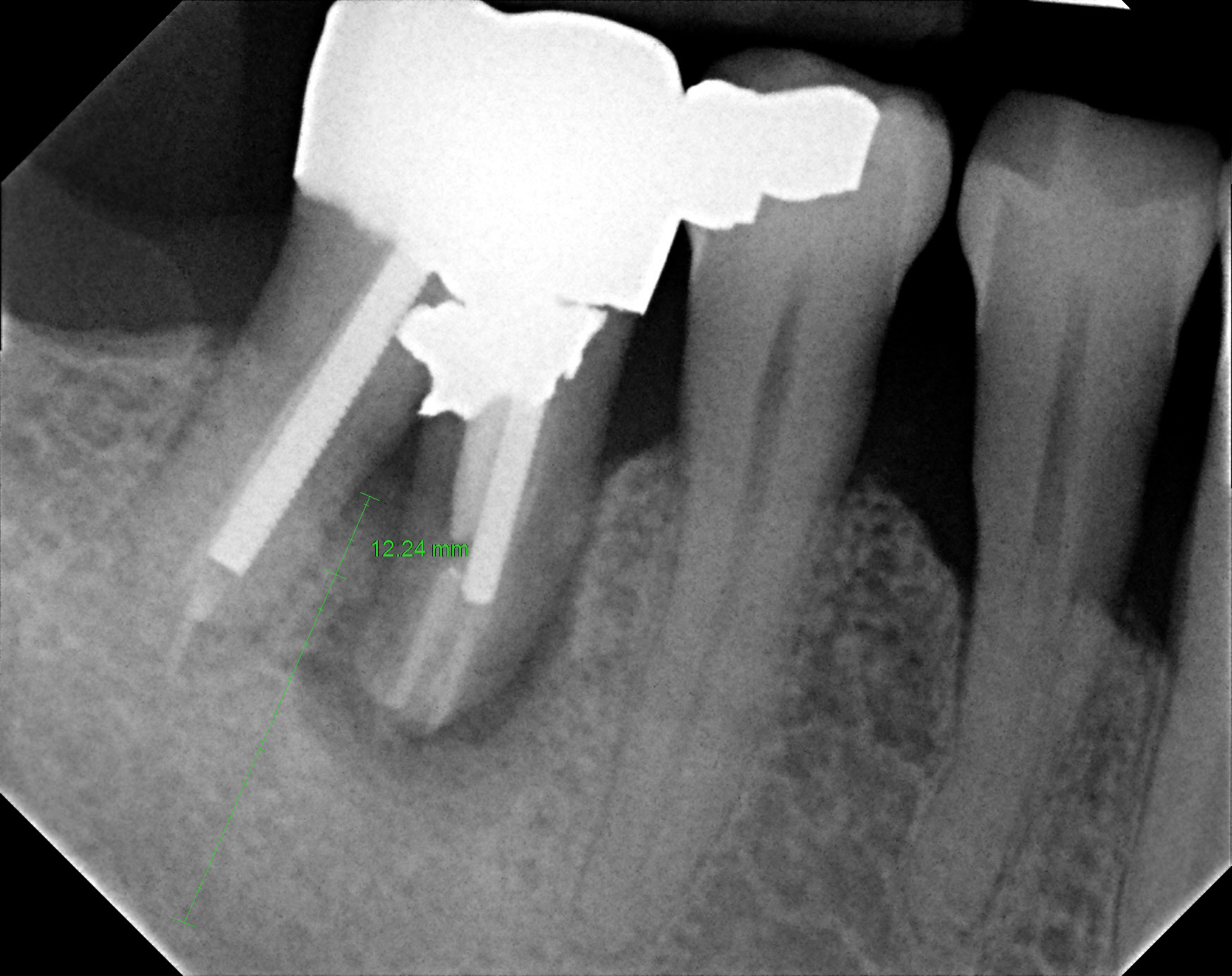 Guided Bone Regeneration before | brandon periodontics
