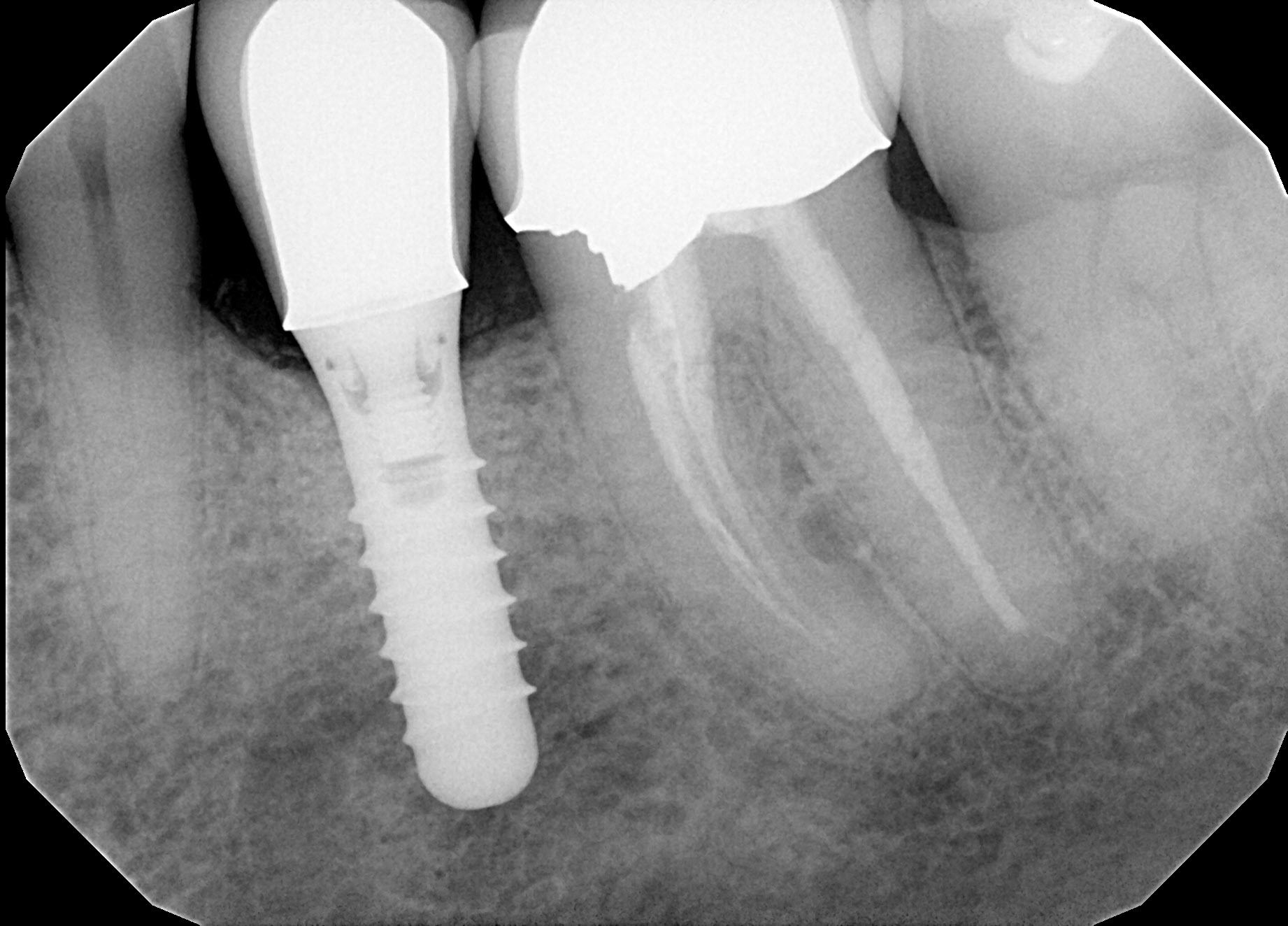 Guided Bone Regeneration after | brandon periodontics