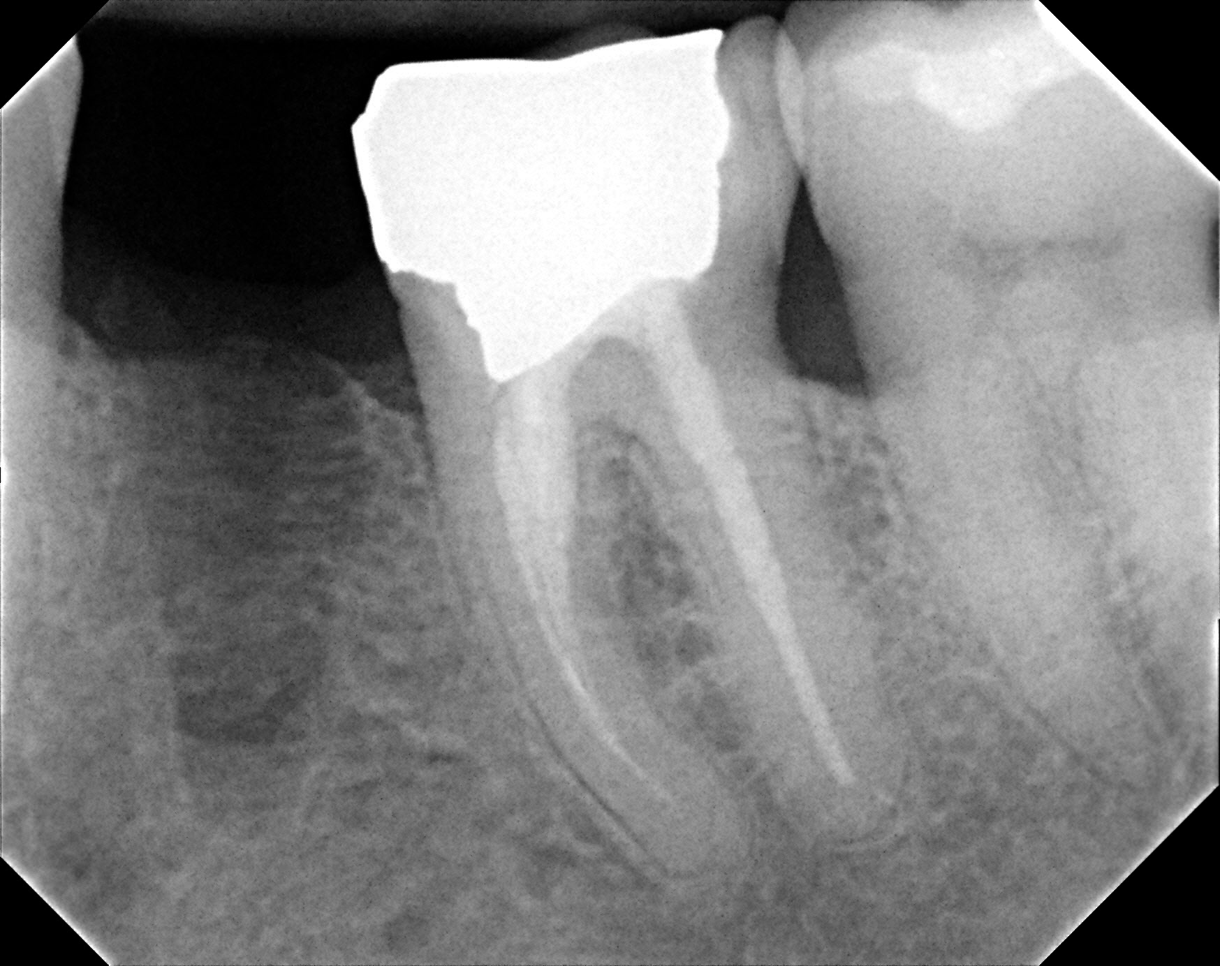 Guided Bone Regeneration before | brandon periodontics