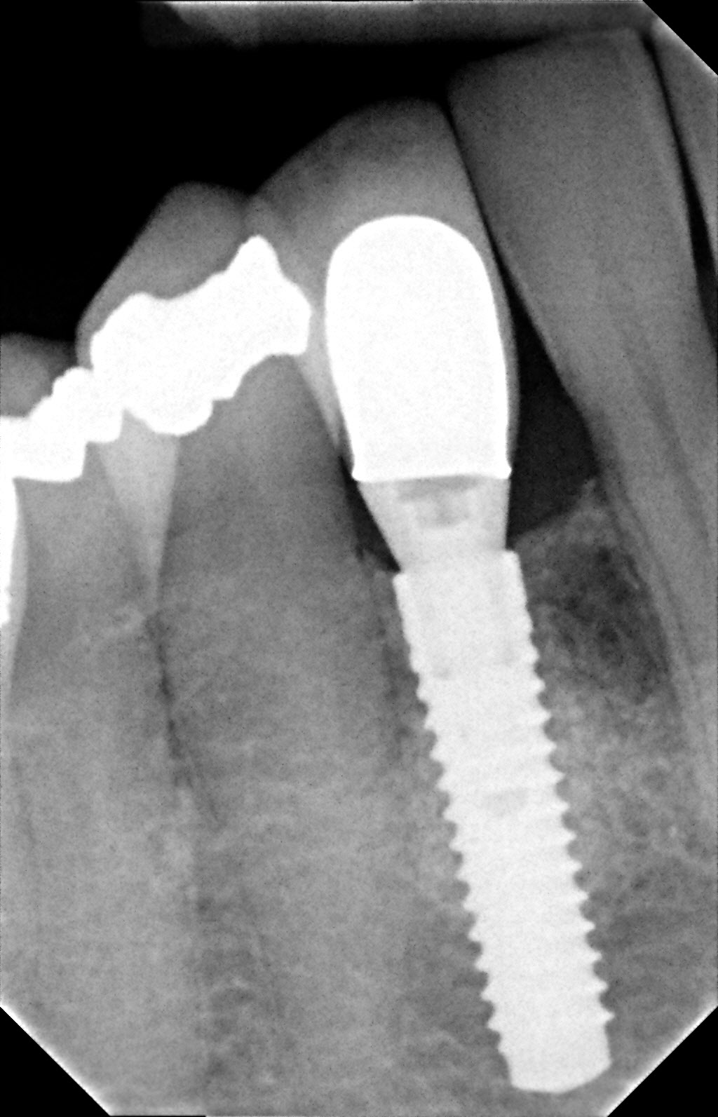 Guided Bone Regeneration After | brandon periodontics