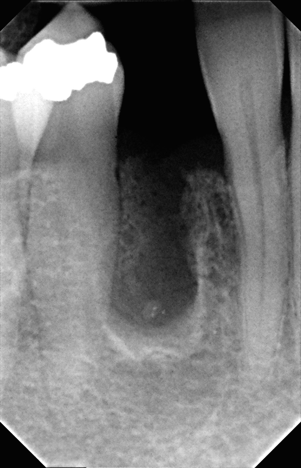 Guided Bone Regeneration Before | brandon periodontics