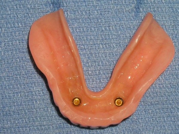 Retain A Denture | brandon dental implant