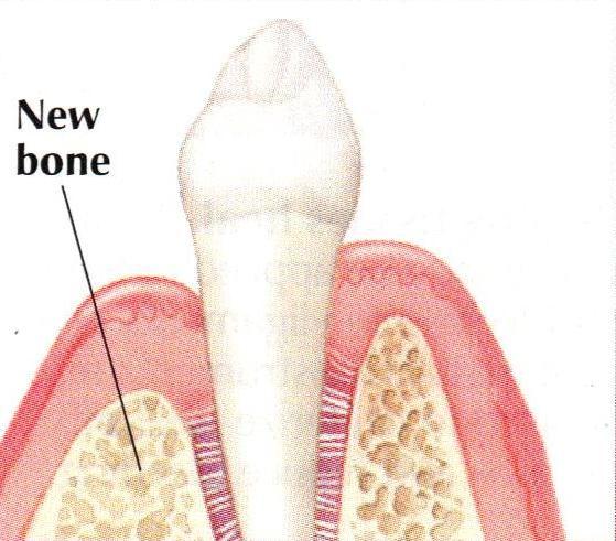 Tissue Regeneration new bone | brandon periodontics