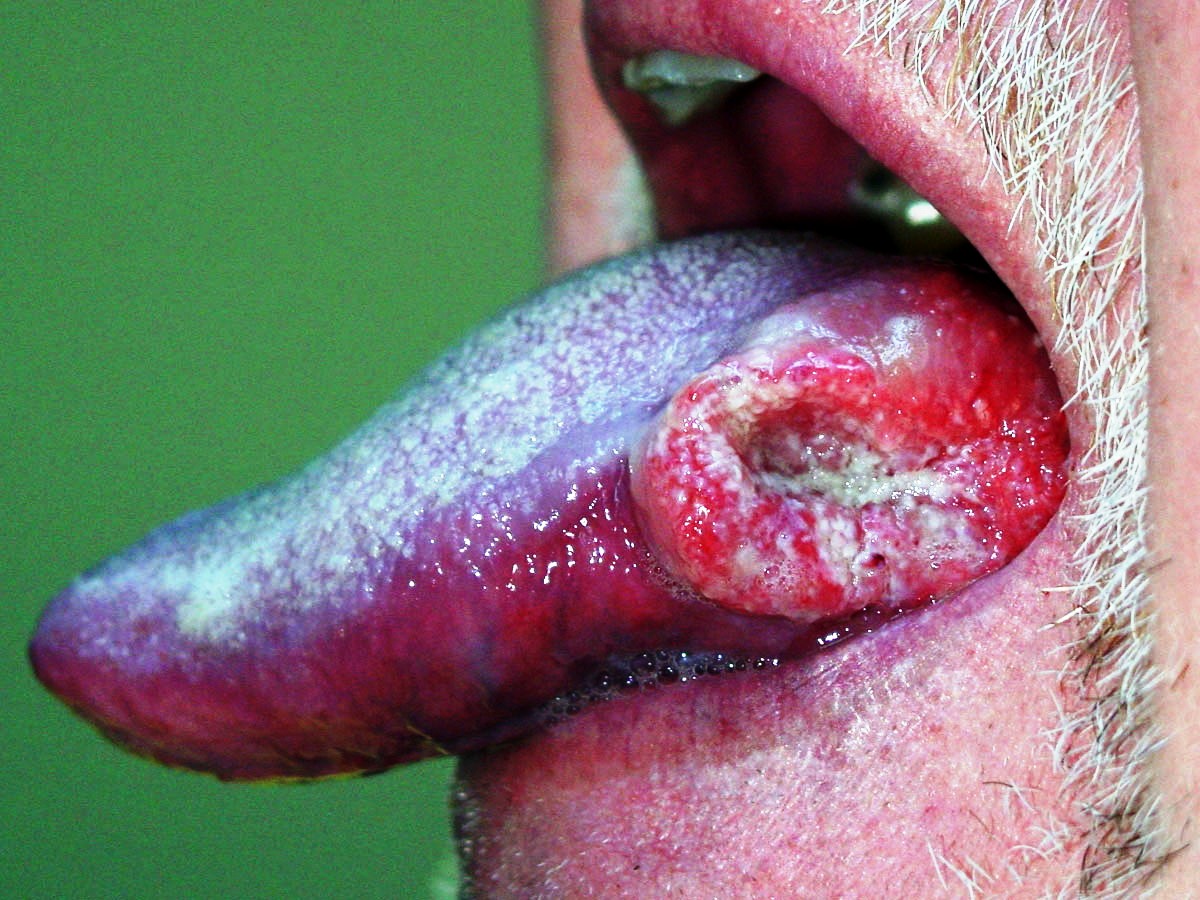 Tongue-Cancer | brandon periodontics