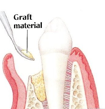bone grafting | brandon periodontics