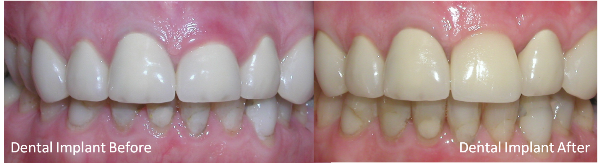single tooth | brandon dental implant