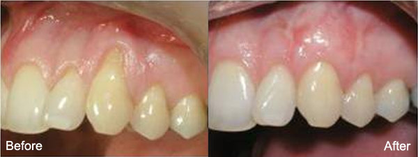 soft tissue grafting | brandon periodontisc