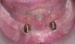 denture retention