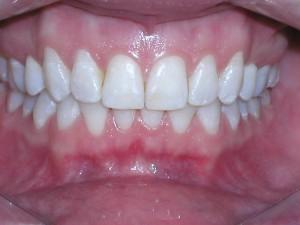 healthy gums