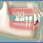 Drifting | brandon dental implant