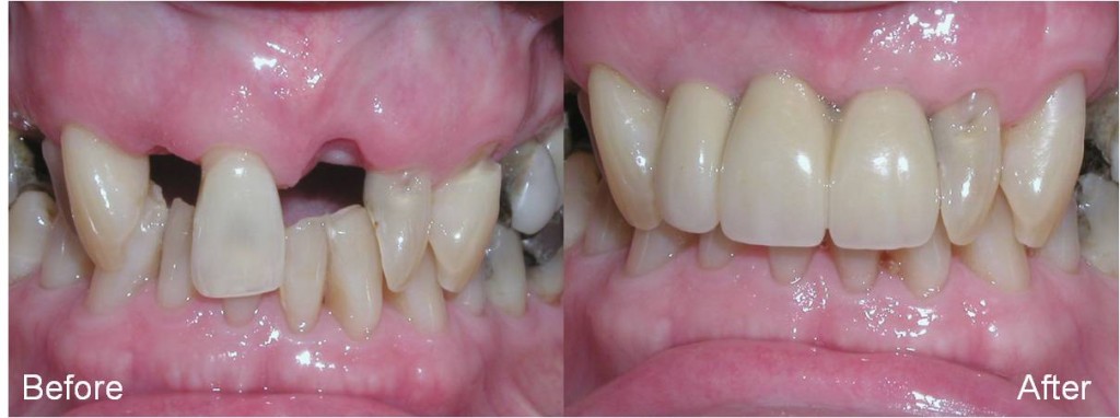 Support | brandon dental implant