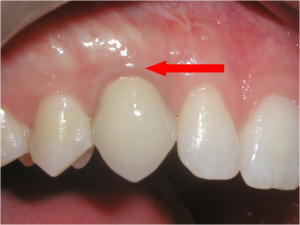Implants Look Natural | brandon dental implant