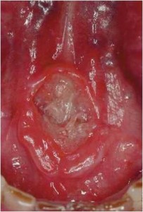 Lesion on Floor of Mouth |brandon oral cancer screening
