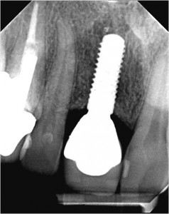 Preserve-The-Bone | brandon dental implant