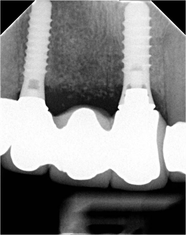 Support | brandon dental implant