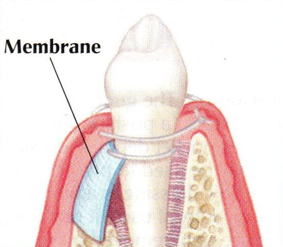 Tissue Regeneration membrane | brandon periodontics