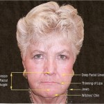 Wrinkling | brandon dental implant