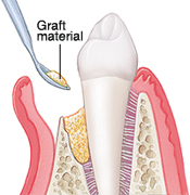 bone grafting | brandon periodontics