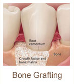 bone-grafting | Brandon Periodontics
