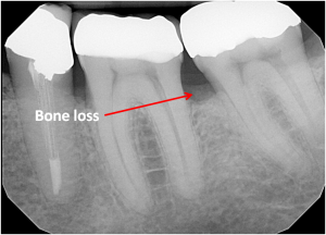 bone loss | brandon periodontics