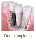 dental-implants | Brandon Periodontics