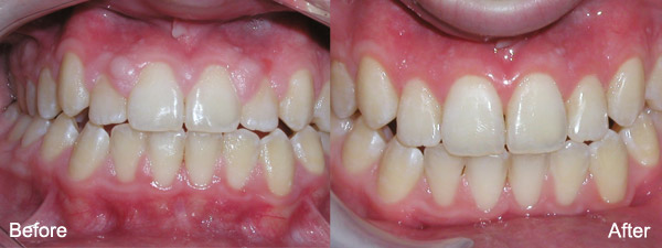 gum recontouring | brandon periodontics