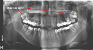 impacted teeth | brandon periodontics
