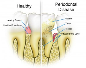 periodontal disease develop | brandon periodontics