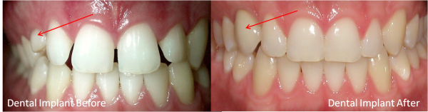single dental implant | brandon dental implant