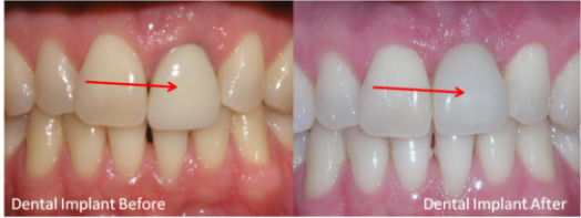 single implant tooth | brandon dental implant