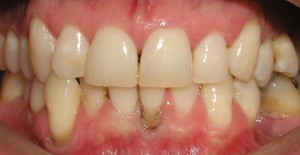 symptoms of periodontal disease | brandon periodontics