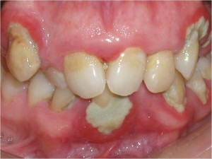what is periodontal disease | brandon periodontics